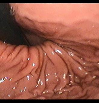 Аксиальная фиксированная кариофундальная грыжа пищеводного отверстия диафрагмы. Атлас эндоскопических изображений endoatlas